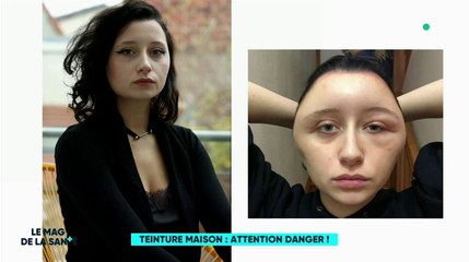 Zapping du 29/11 : Défigurée à cause d’une coloration pour cheveux