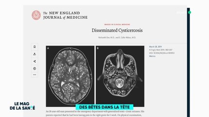 Zapping du 04/04 : On lui découvre des centaines de vers dans le cerveau !