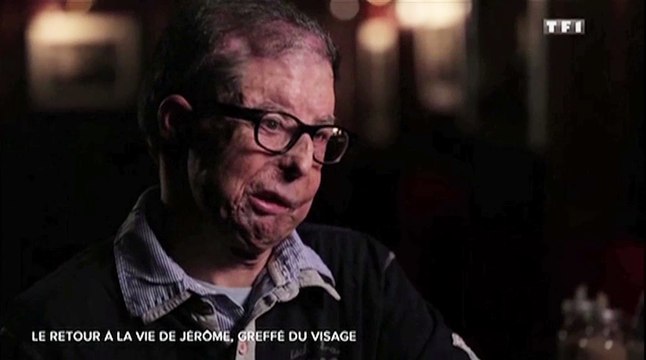 Le zapping du 20/04 : Greffe totale du visage : les confidences de Jérôme Hamon