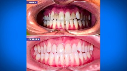 bd-calzas-dentales-desajustadas-100322