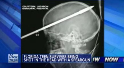 Etats-Unis : il survit avec une lance de harpon logée dans le crâne !