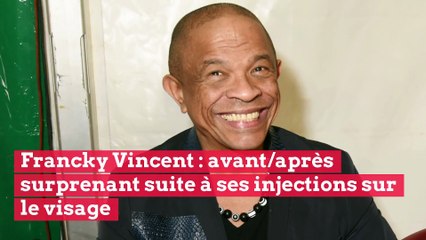Francky Vincent : avant/après surprenant suite à ses injections sur le visage