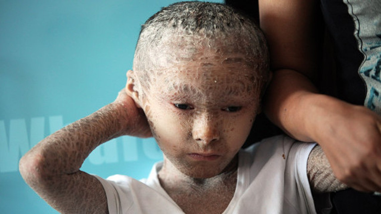 Appelés ''enfant-poisson'', ces enfants à la peau asséchée souffre d'ichtyose
