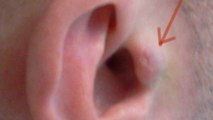 Echolocation : cet homme s'implante des écouteurs dans l'oreille pour 