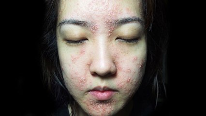 Bun Bun : La blogueuse mode se retrouve défigurée après l'essai d'une crème de beauté