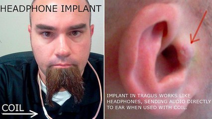 Fan de musique, Rich Lee se fait greffer des écouteurs directement dans l'oreille