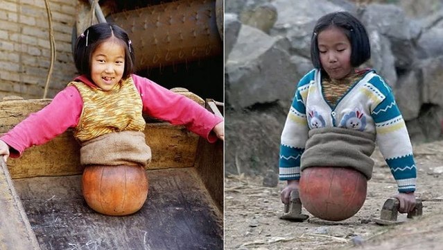 On sait ce qu'est devenue la jeune fille amputée qui a appris à marcher avec un ballon de basket !