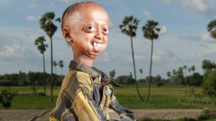 Atteint de progéria, ce garçon de 14 ans a le corps d'un homme de 110 ans