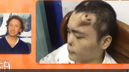 Après un accident, on lui fait pousser un nez sur le front