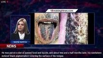 Stroke victim's tongue turns BLACK and 'HAIRY' because of his pureed diet - 1breakingnews.com