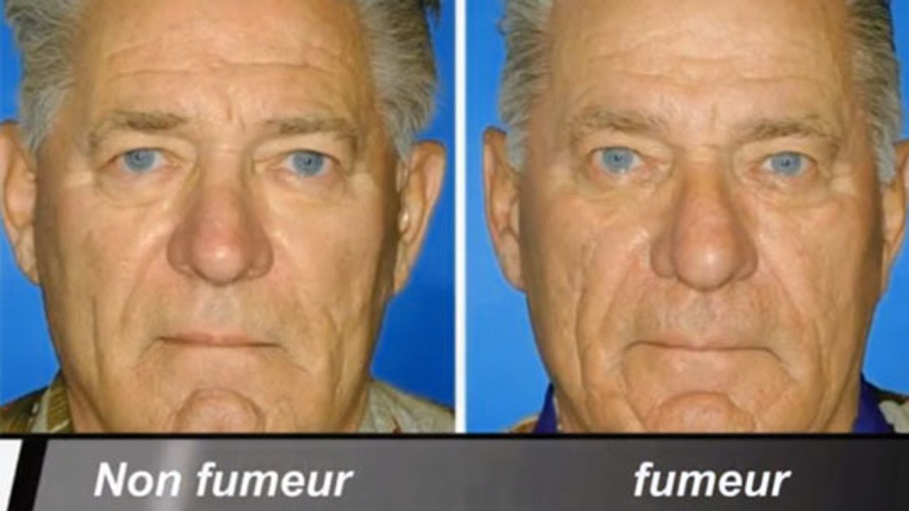 Tabac : les effets de la cigarette comparés sur des jumeaux fumeurs et non-fumeurs