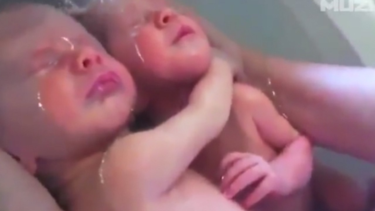 Après leur naissance, ces jumeaux refusent se détacher l'un de l'autre