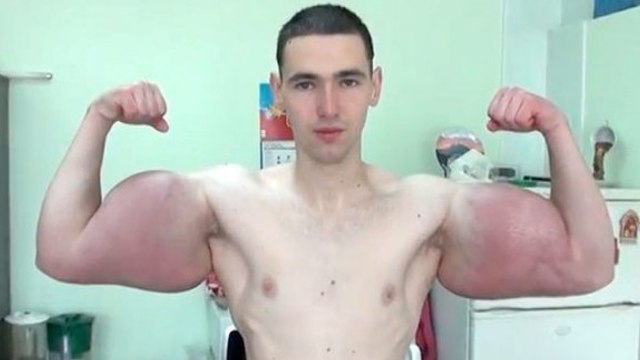 Synthol Kid : Les terribles effets secondaires chez le fou qui s'injectait du Synthol pour avoir des bras à la Popeye
