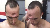 Muay thaï : la terrible blessure au crâne d'un combattant français