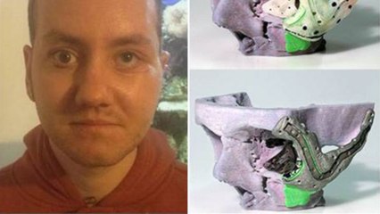 Son visage déformé a été reconstruit grâce à une imprimante 3D