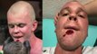 UFC Hambourg : Stefan Struve termine son combat contre Marcin Tybura avec une énorme entaille au menton