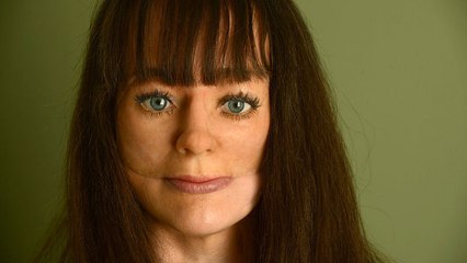 Après avoir reçu une balle en plein visage, Michelle Fox porte une prothèse ultra-réaliste