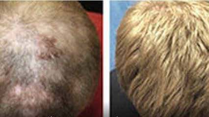 Condamné à rester chauve, Kyle Rhodes a retrouvé ses cheveux grâce à un traitement inattendu