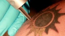 Voilà comment on efface un tatouage...au laser