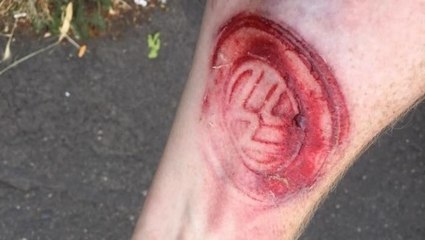 Il trouve le logo Volkswagen tatoué sur son bras après un accident de voiture