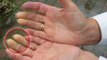 La maladie Raynaud : Une douleur pénible aux doigts provoquée par le froid