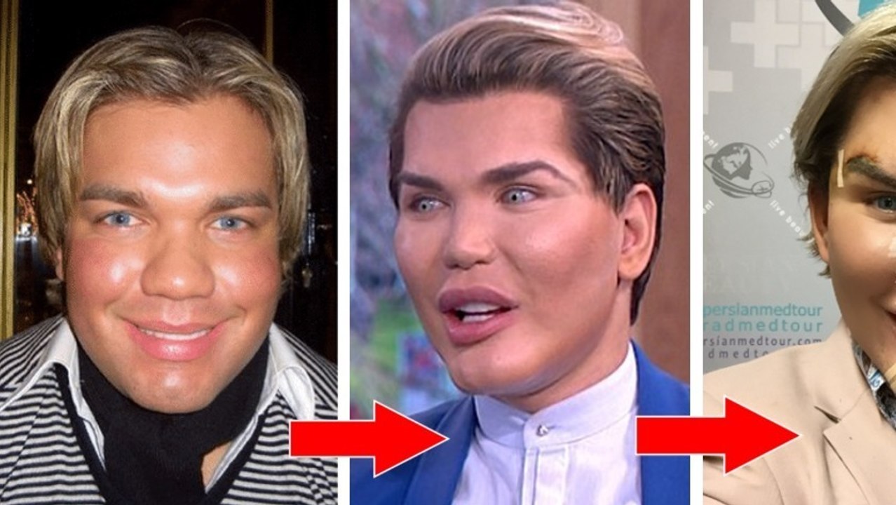 Rodrigo Alves : le Ken humain vient de se faire poser 24 000€ de dents en porcelaine
