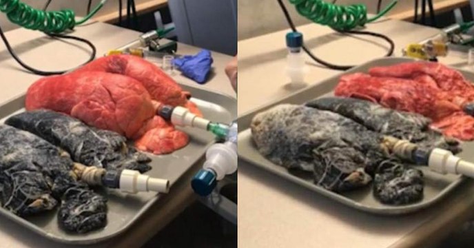 Journée mondiale sans tabac : la différence choquante entre des poumons sains et ceux d'une personne qui fume un paquet par jour (VIDEO)