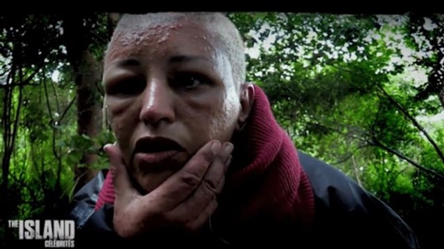 The Island Célébrités : défigurée, Lââm fond en larmes en découvrant son visage