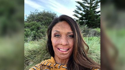 Turia Pitt : L'incroyable histoire de cette jeune femme brulée sur 70% de son corps (Photos)
