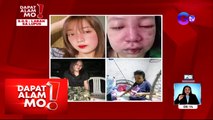 Dapat Alam Mo!: Tumubong mga butlig at sugat sa mukha, indikasyon pala ng malalang sakit?