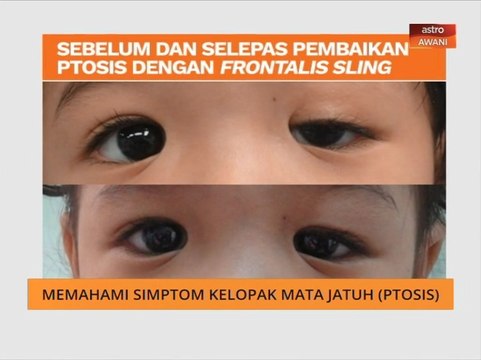 Kelopak mata jatuh (Ptosis) tidak sama dengan sepet