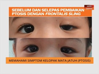 Kelopak mata jatuh (Ptosis) tidak sama dengan sepet