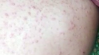 Is this Lumpy skin desease in Human patient?