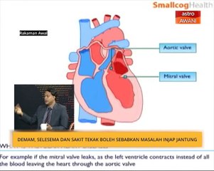 Demam, selsema dan sakit tekak boleh sebabkan masalah injap jantung