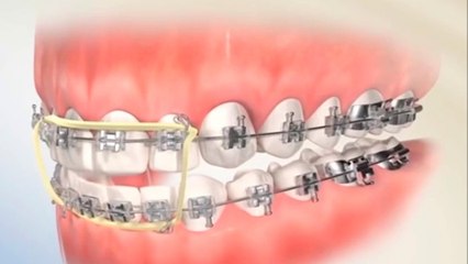 bd-corrija-problemas-dentales-con-el-uso-de-frenillos-160322