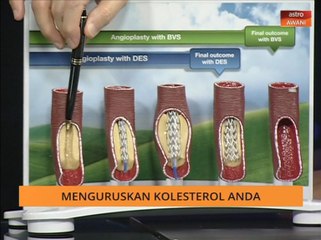 Rawatan pembuluh darah sempit di jantung akibat kolestrol mahal