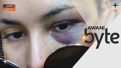 #AWANIByte: Muka dan tubuh lebam, Izara kongsi cerita kemalangan di lokasi penggambaran