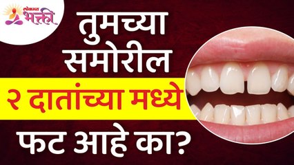 समोरील दोन दातांच्या मध्ये फट असल्यावर काय करावे? Crack between the two front teeth | Teeth tips