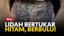 Lidah bertukar hitam, berbulu!