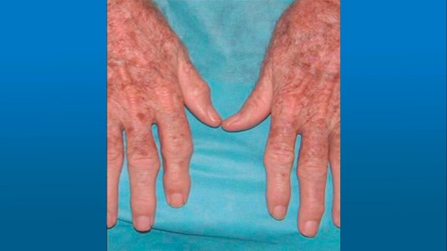 bd-hablamos-sobre-osteoartritis-durante-la-menopausia-170322