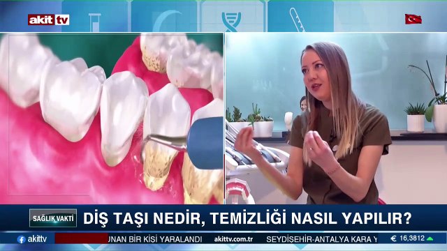 Diş taşı nedir, temizliği nasıl yapılır?