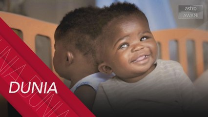 Kembar Siam bercantum di tengkorak berjaya dipisahkan