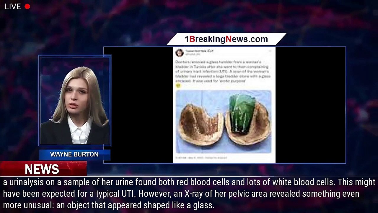 Glass Tumbler Found In Woman's Urinary Bladder 4 Years After Use As Sex