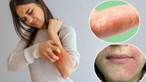 गर्मी में इस कारण से हो सकती है  Eczema जैसी भयानक बीमारी | क्या है लक्षण और घरेलू उपचार |Boldsky