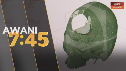 Teknorintis: Implan cetakan 3D khusus dibangunkan syarikat teknologi tempatan