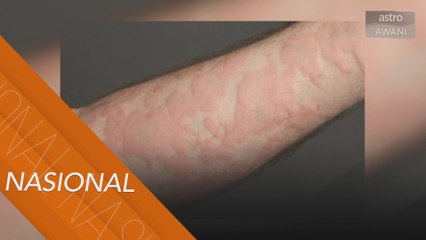 Perhati pemakanan anak-anak sekiranya terkena gegata