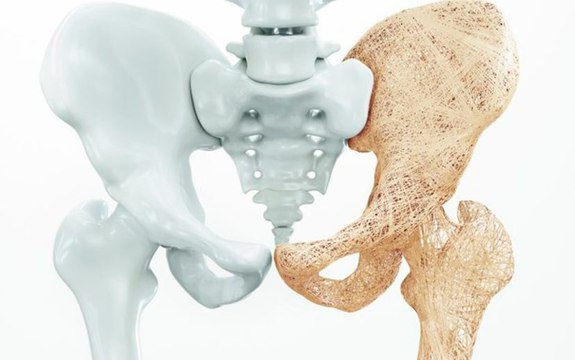 Médico reumatologista fala sobre sintomas, tratamentos e causas das Osteoporose