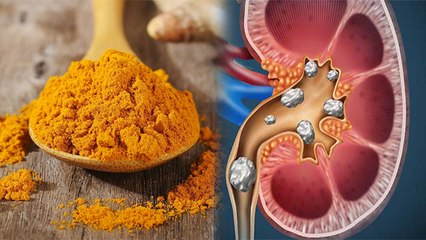 हल्दी खाने पथरी में है जानलेवा चौका देगी वजह । Doctors Alert । Boldsky