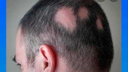 bd-perdida-de-cabello-por-estres-220322