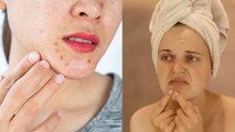 Chin पर Pimples होने का कारण | ठोड़ी पर पिंपल के उपाय |Boldsky